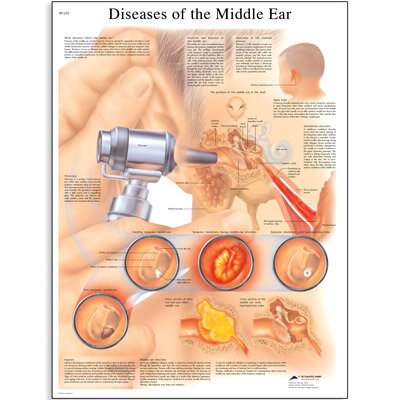Diseases of the Middle Ear VR1252 Poster